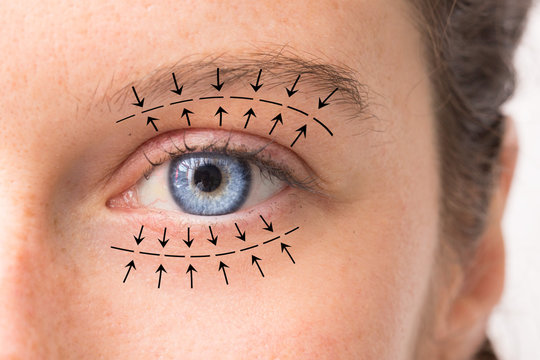 Oculoplasty