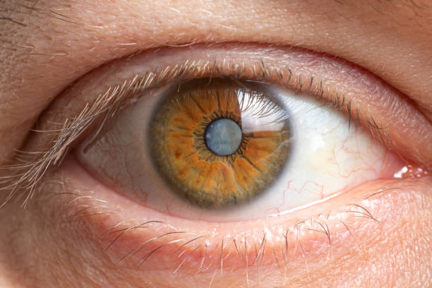 Cataract & Refractive 